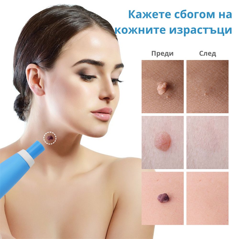 TagClean™ комплект за кожа – Премахнете кожните израстъци бързо и лесно.